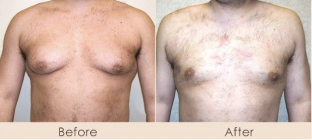Male Chest External Ultrasound Assisted Liposuction and MPX smart lipo